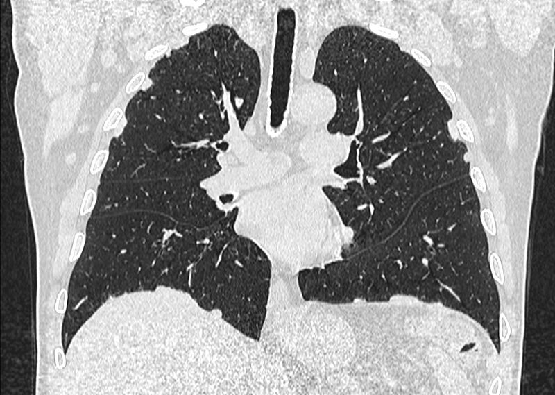 File:Asbestos pleural placques (Radiopaedia 57905-64872 Coronal lung window 146).jpg