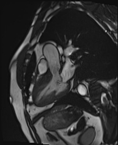 File:Asymmetric septal hypertrophic cardiomyopathy - systolic anterior motion of mitral leaflet (Radiopaedia 72795-83445 B 3).jpg