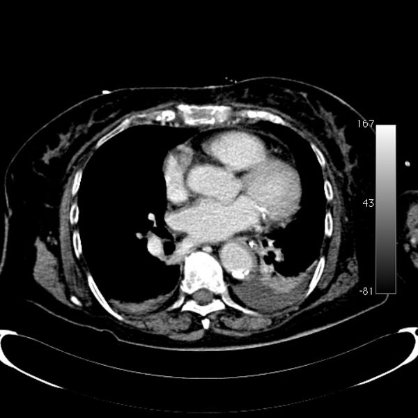 File:Atypical dissection of the thoracic aorta (Radiopaedia 10975-78320 A 40).jpg