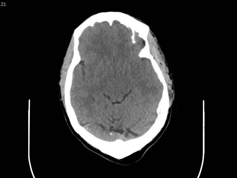 File:Atypical meningioma - intraosseous (Radiopaedia 64915-73867 A 21).jpg