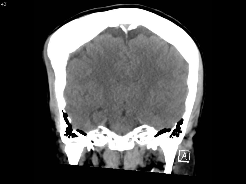 Atypical meningioma - intraosseous (Radiopaedia 64915-73867 B 41).jpg