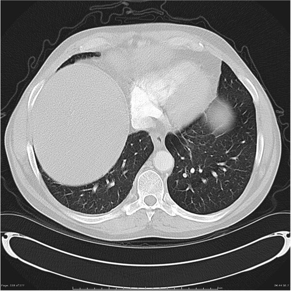 File:Atypical pneumonia - Q fever (Radiopaedia 21993-21989 lung window 37).jpg