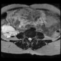 Atypical retroperitoneal lymphocoeles with large leiomyoma of uterus (Radiopaedia 32084-33027 Axial T2 6).jpg