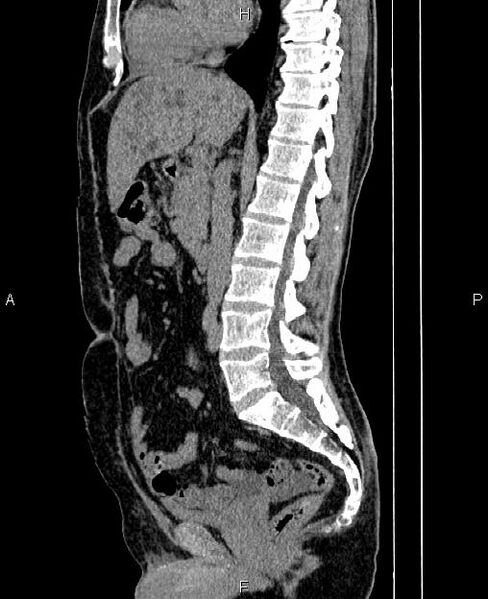 File:Autosomal dominant polycystic kidney disease (Radiopaedia 87830-104287 C 44).jpg