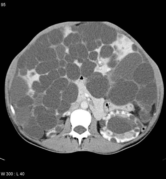 File:Autosomal dominant polycystic kidney disease with extensive hepatic involvement (Radiopaedia 5204-6971 B 12).jpg