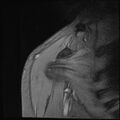 Avulsion fracture - greater tuberosity of humerus (Radiopaedia 71216-81515 Coronal T2 16).jpg