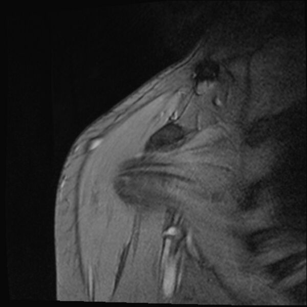 File:Avulsion fracture - greater tuberosity of humerus (Radiopaedia 71216-81515 Coronal T2 16).jpg