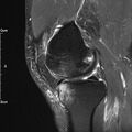 Avulsion fracture of the fibular head (Radiopaedia 74804-85808 Sagittal PD fat sat 13).jpg