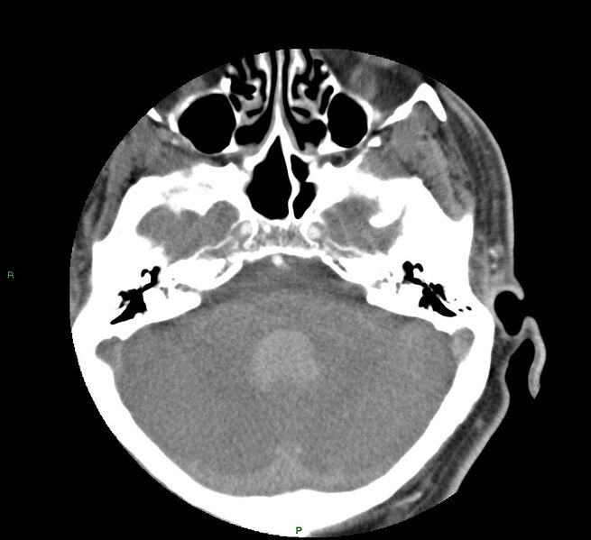 File:Basal ganglia hemorrhage (Radiopaedia 58763-65985 D 48).jpg
