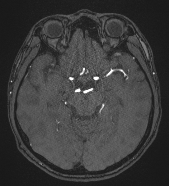 File:Basal ganglia subacute infarct (Radiopaedia 80201-93521 Axial MRA 55).png