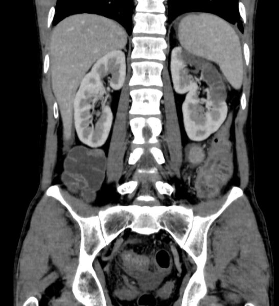 File:Behçet's disease- abdominal vasculitis (Radiopaedia 55955-62570 B 43).jpg