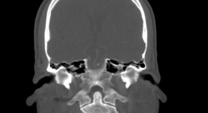 File:Benign mixed salivary tumor of the parotid gland (Radiopaedia 35261-36792 Coronal bone window 19).jpg