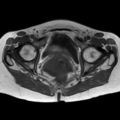 Bicornuate uterus (Radiopaedia 61974-70046 Axial T1 35).jpg