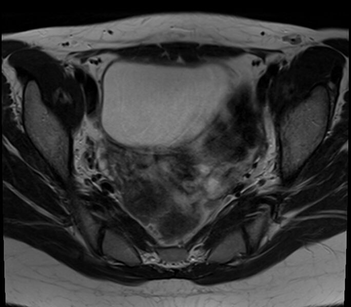 File:Bicornuate uterus (Radiopaedia 71214-81511 Axial T2 19).jpg