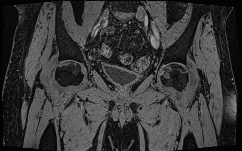 Bilateral avascular necrosis of femoral head (Radiopaedia 77116-89078 Coronal T2 we 49).jpg