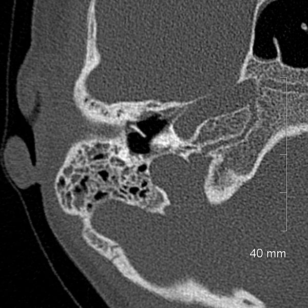 File:Bilateral grommets (Radiopaedia 47710-52404 Axial bone window 30).jpg