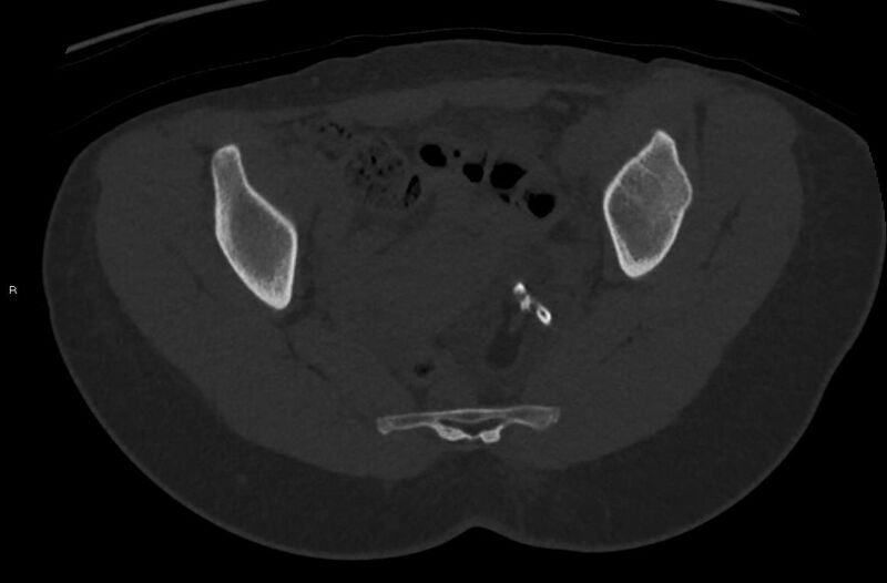 File:Bilateral mature cystic ovarian teratoma (Radiopaedia 88821-105592 Axial bone window 22).jpg