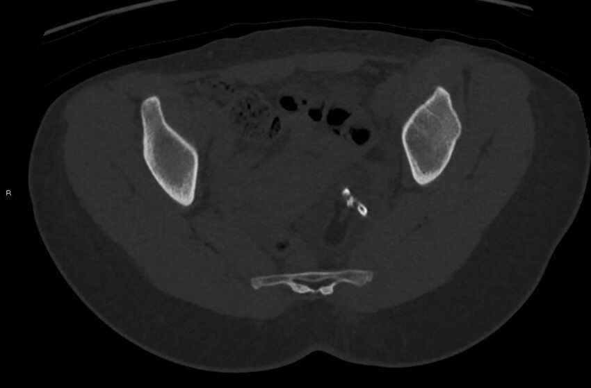Bilateral mature cystic ovarian teratoma (Radiopaedia 88821-105592 Axial bone window 22).jpg