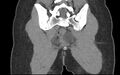 Bilateral mature cystic ovarian teratoma (Radiopaedia 88821-105592 Coronal non-contrast 37).jpg