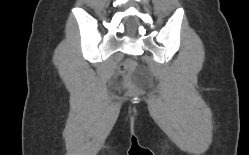 File:Bilateral mature cystic ovarian teratoma (Radiopaedia 88821-105592 Coronal non-contrast 37).jpg