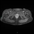 Bilateral ovarian fibroma (Radiopaedia 44568-48293 Axial T1 C+ fat sat 27).jpg