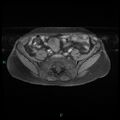 Bilateral ovarian fibroma (Radiopaedia 44568-48293 Axial T1 fat sat 4).jpg