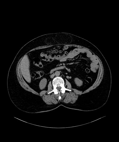 File:Bilateral sporadic synchronous clear cell renal cell carcinoma (Radiopaedia 85035-100572 Axial non-contrast 35).jpg