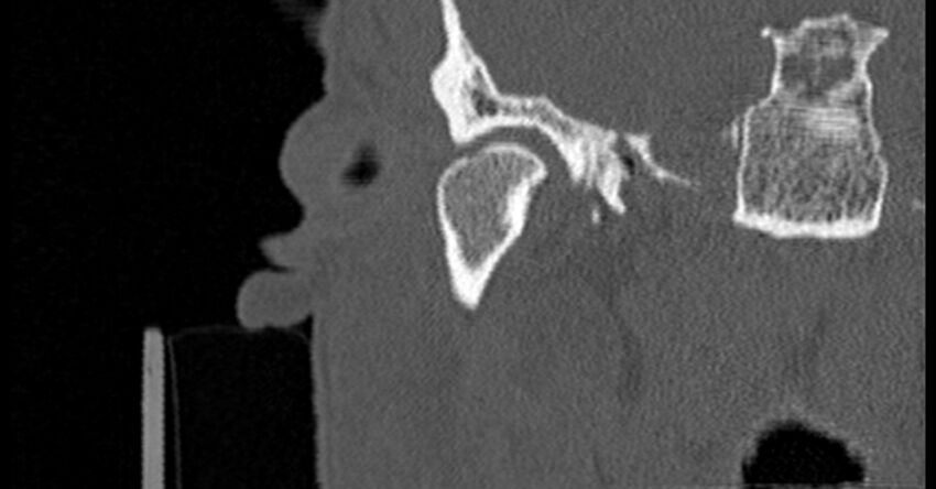 Bilateral temporal bone fractures (Radiopaedia 29482-29970 Coronal non-contrast 56).jpg