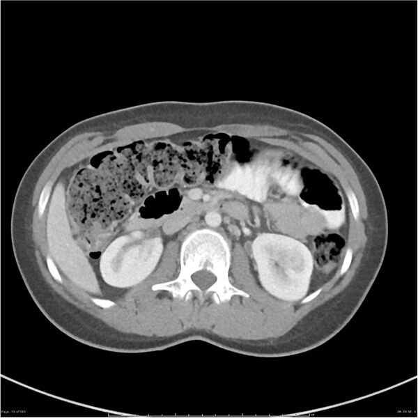 File:Bilateral ureteritis and cystitis (Radiopaedia 25340-25594 A 29).jpg