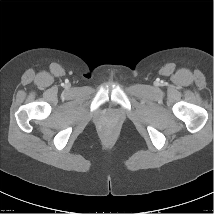 Bilateral ureteritis and cystitis (Radiopaedia 25340-25594 A 80).jpg