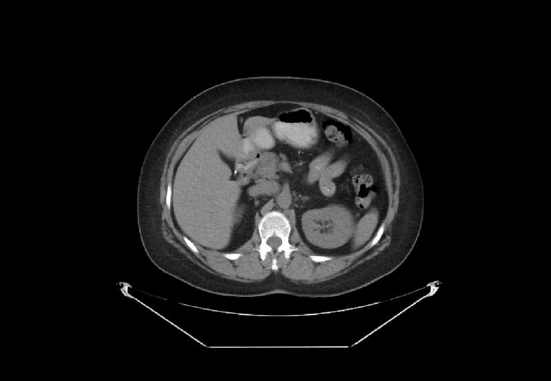 File:Bilateral urolithiasis with incidentally detected splenic artery aneurysm and left inferior vena cava (Radiopaedia 44467-48123 Axial non-contrast 15).jpg