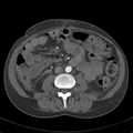 Biliary necrosis - liver transplant (Radiopaedia 21876-21846 A 41).jpg