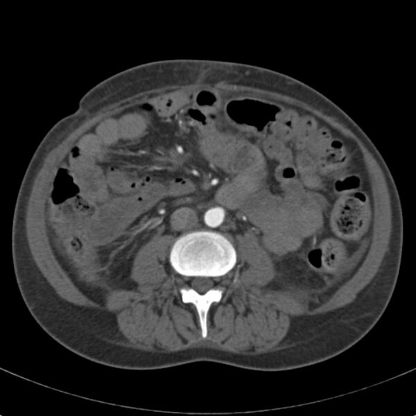 File:Biliary necrosis - liver transplant (Radiopaedia 21876-21846 A 41).jpg