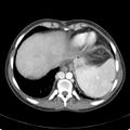 Biliary necrosis - liver transplant (Radiopaedia 21876-21846 B 8).jpg