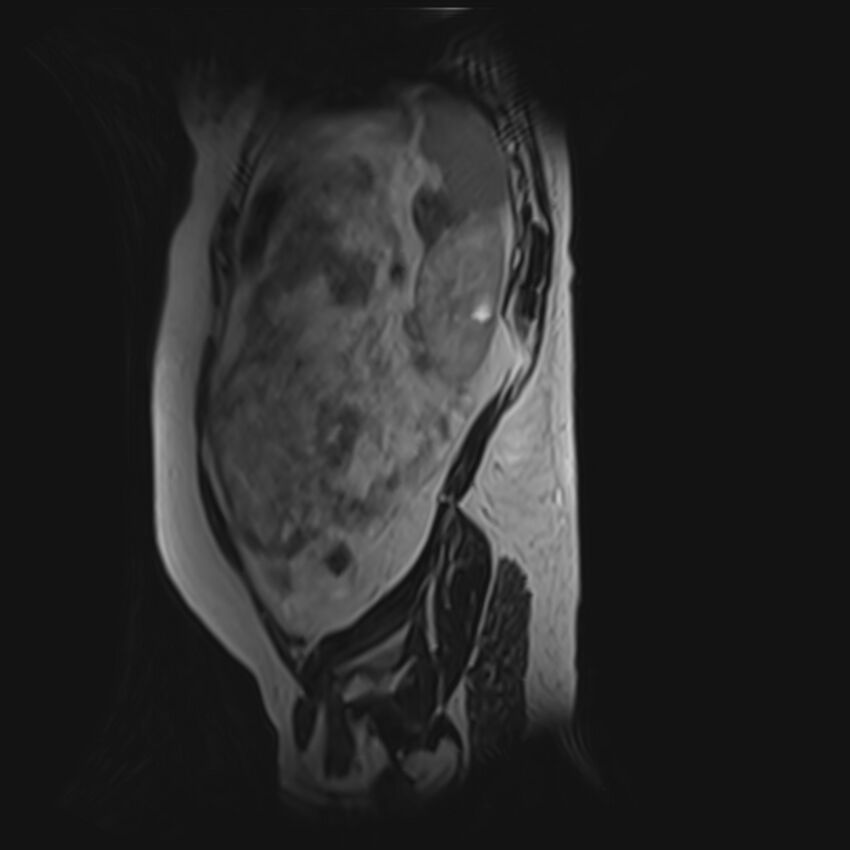 Bilobed placenta accreta (Radiopaedia 69648-79591 G 9).jpg