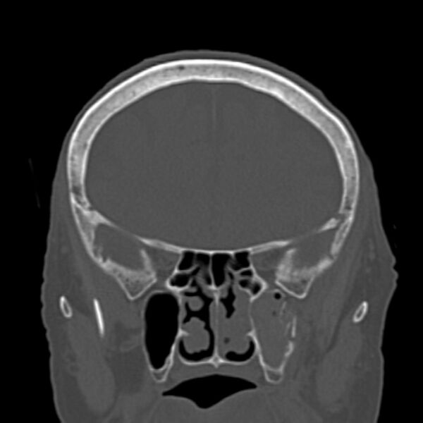 File:Biparietal osteodystrophy (Radiopaedia 46109-50463 Coronal bone window 37).jpg