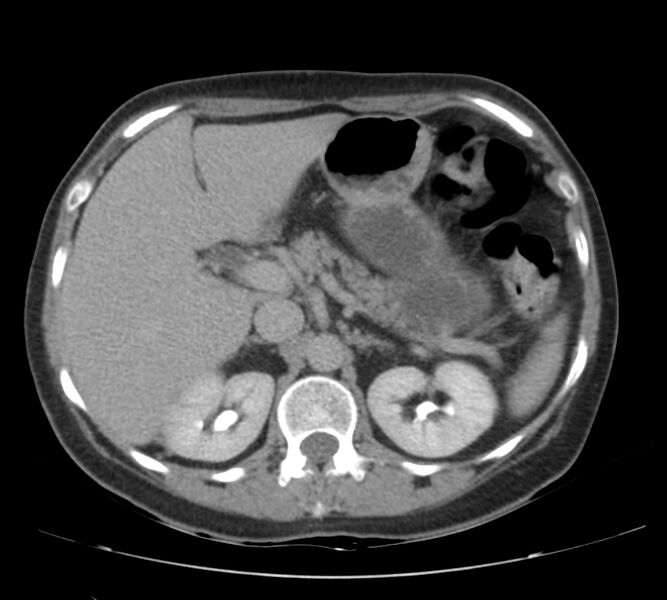 File:Bosniak renal cyst - type IV (Radiopaedia 22929-22953 D 17).jpg