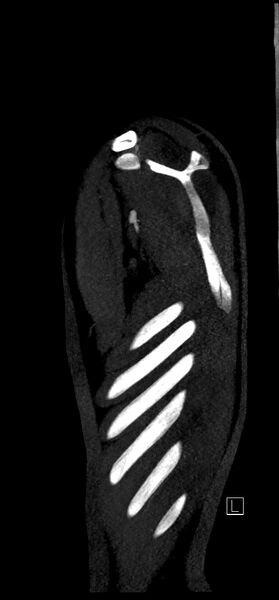 File:Brachiocephalic trunk pseudoaneurysm (Radiopaedia 70978-81191 C 91).jpg