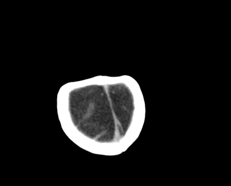 File:Brachycephaly (bi-coronal and bi-lambdoid synostosis) (Radiopaedia 55048-61413 Axial non-contrast 52).jpg