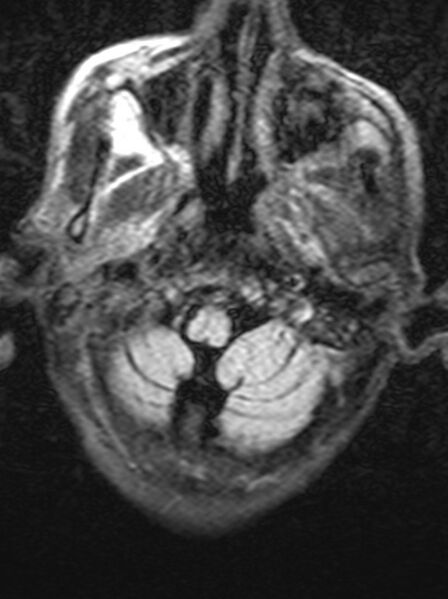 File:Brain abscess with dual rim sign (Radiopaedia 87566-103938 Axial FLAIR 2).jpg