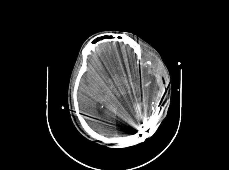 File:Brain injury by firearm projectile (Radiopaedia 82068-96087 B 105).jpg