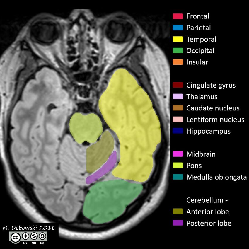 Brain lobes - annotated MRI (Radiopaedia 61691-69700 Axial 53).JPG