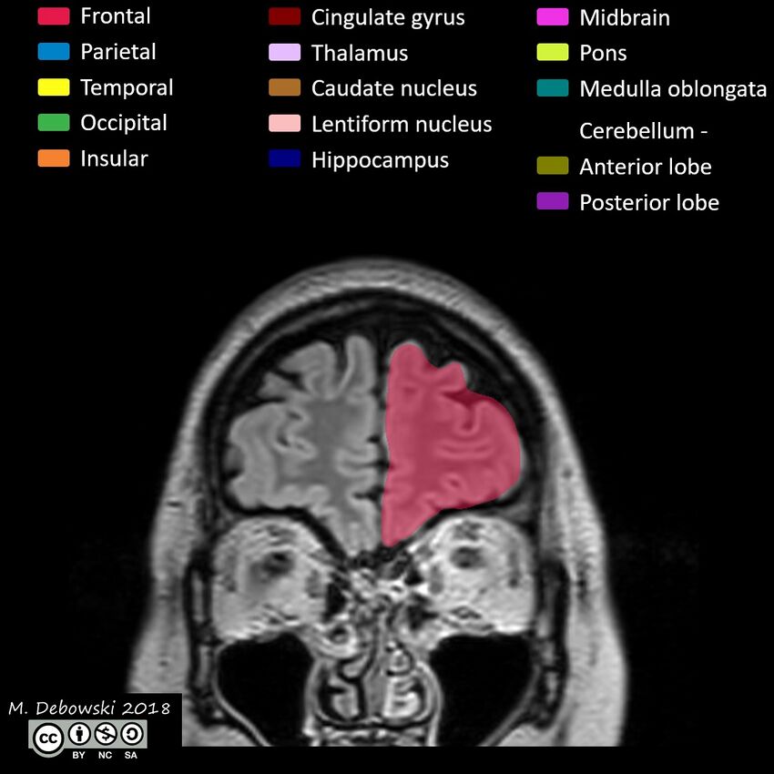 Brain lobes - annotated MRI (Radiopaedia 61691-69700 Coronal 7).JPG