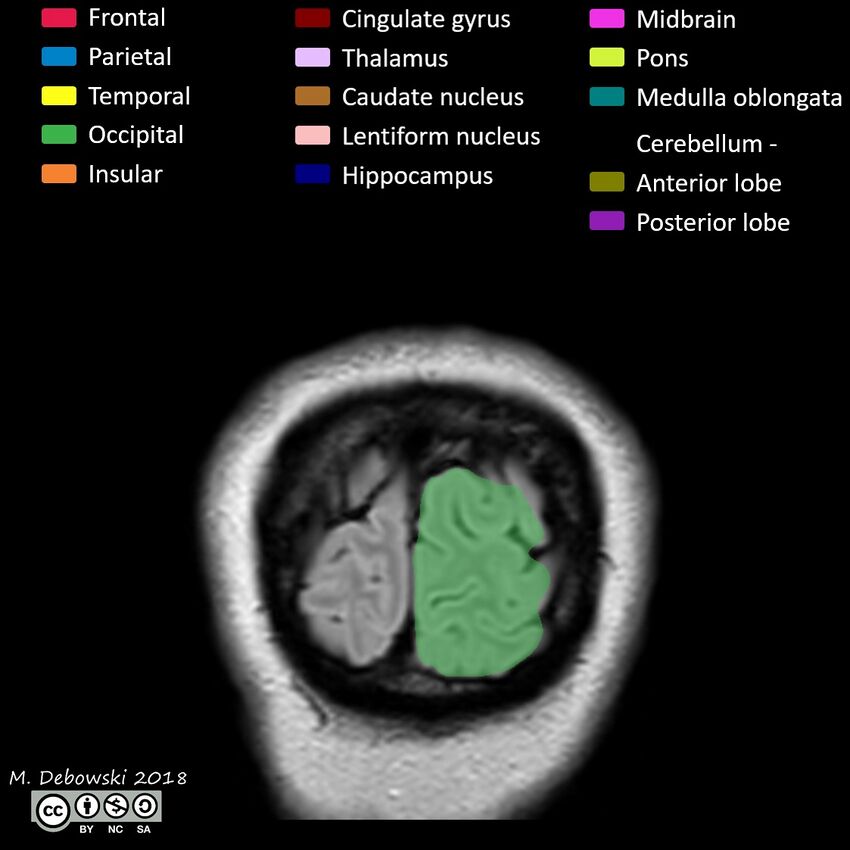 Brain lobes - annotated MRI (Radiopaedia 61691-69700 Coronal 72).JPG