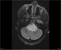 Brainstem glioma (Radiopaedia 21819-21775 Axial FLAIR 9).jpg