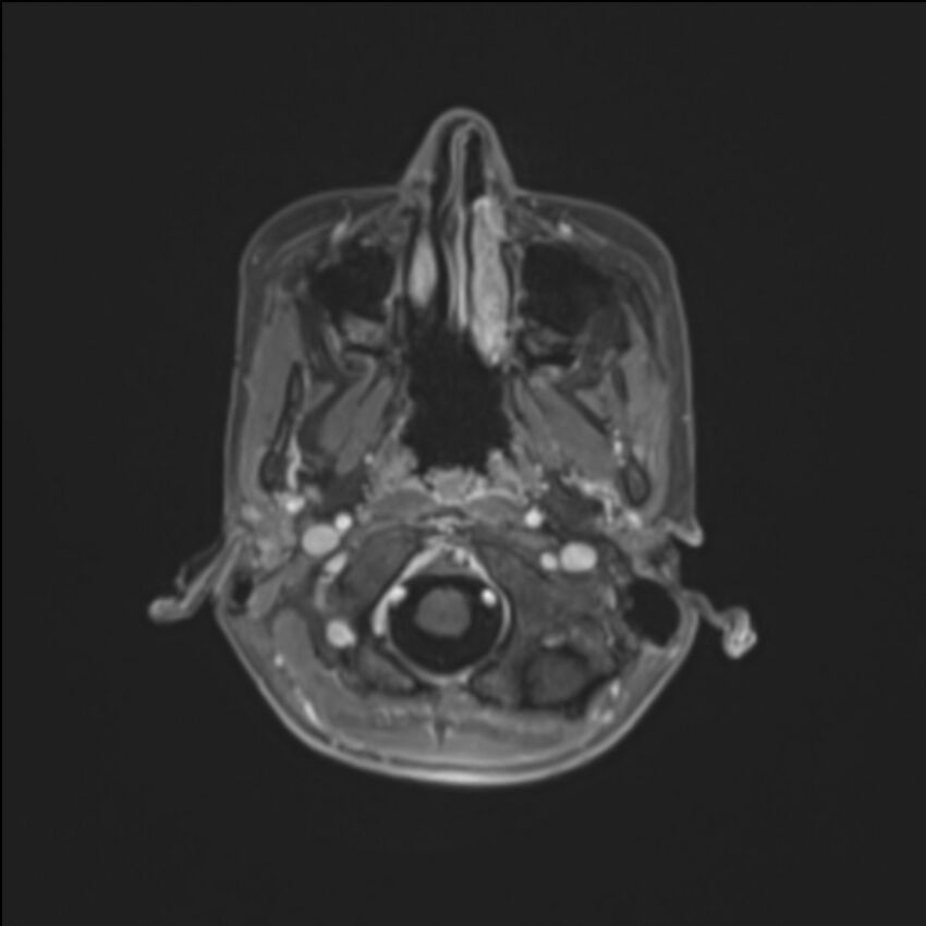 Brainstem glioma (Radiopaedia 70548-80674 Axial T1 C+ 20).jpg