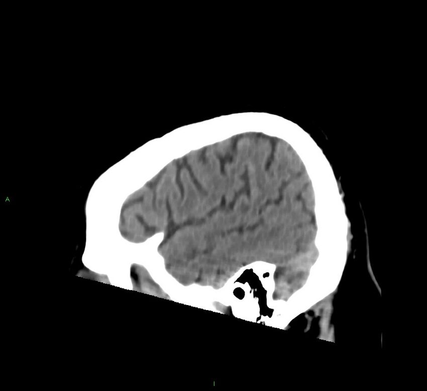 Brainstem hemorrhage (Radiopaedia 58794-66028 C 9).jpg