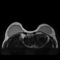 Breast implants - MRI (Radiopaedia 26864-27035 Axial T2 14).jpg