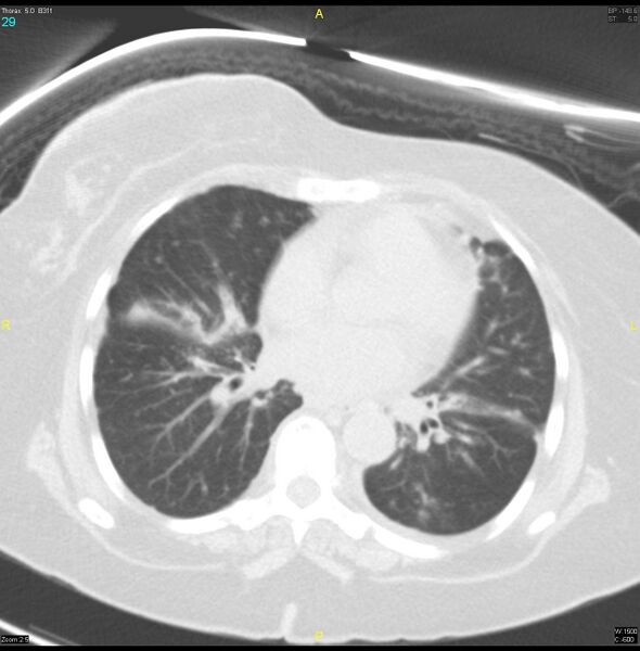 File:Breast primary with lung and bone metastases (Radiopaedia 40620-43228 Axial lung window 29).jpg
