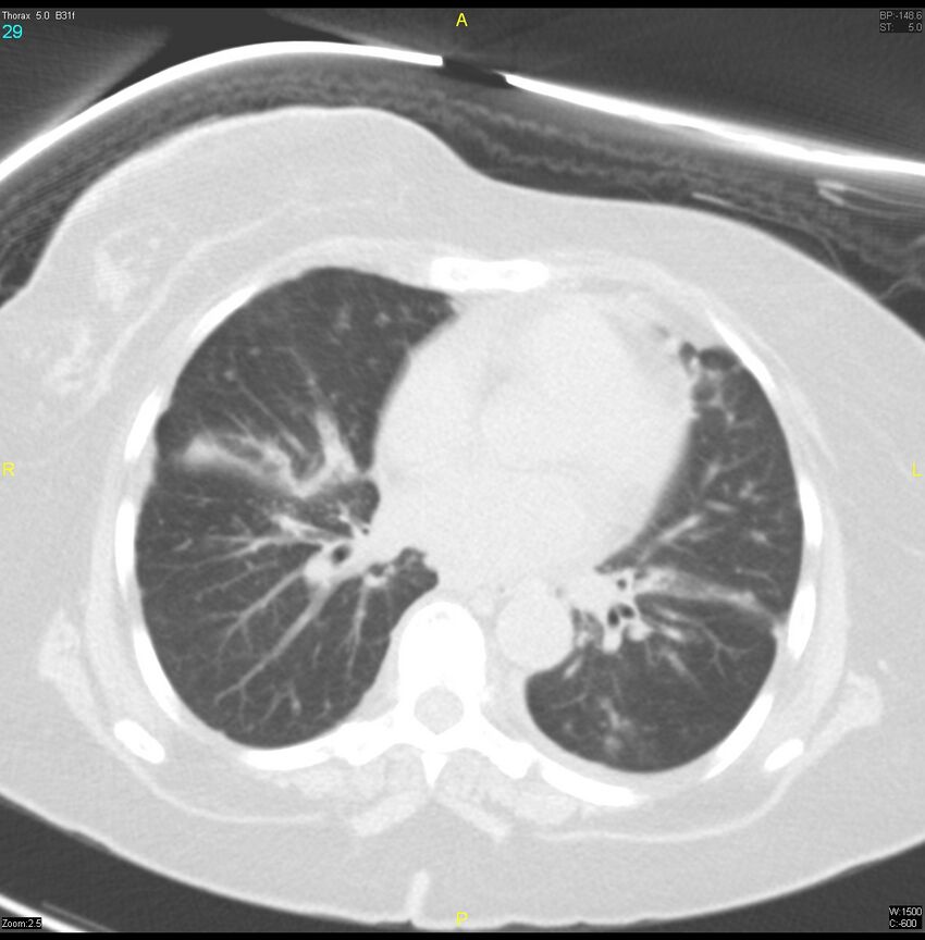 Breast primary with lung and bone metastases (Radiopaedia 40620-43228 Axial lung window 29).jpg